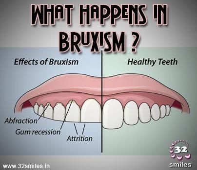 What is Bruxism?