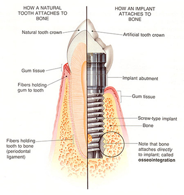 Dental Implant Diagram