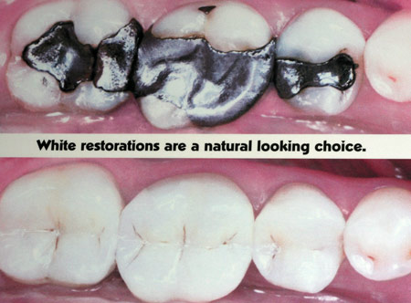 Restorative Dentistry - Fillings